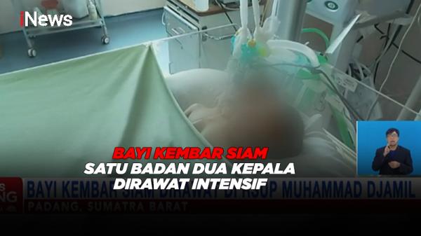 Bayi Kembar Siam Satu Badan Dua Kepala Dirawat Intensif di RSUP Djamil Padang
