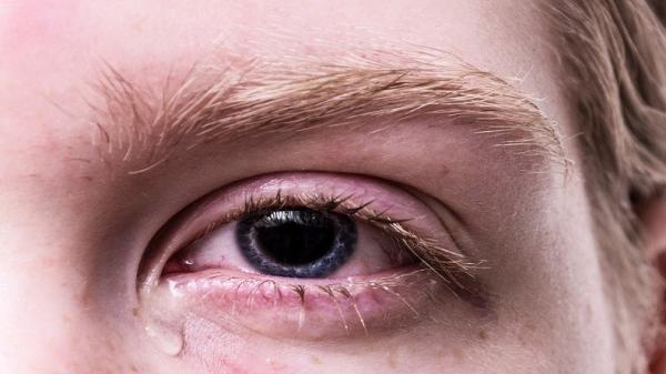 Ilustrasi Bahaya Menggunakan Softlens Setiap Hari (Foto: Pixabay)