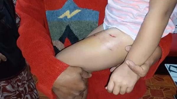 Digigit anjing Bocah perempuan berusia 4 tahun di Bukittinggi, Sumbar, digigit anjing (Wahyu Sikumbang/MNC Portal)