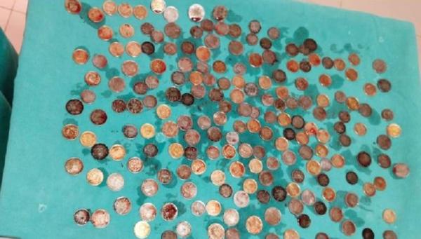 Ada 187 Koin dengan Berat Total 1,5 Kg di Perut Orang Ini, kok Bisa?