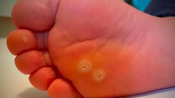 Cara Mengobati Mata Ikan di Kaki dengan Bahan Alami, Oleskan Pepaya hingga Jeruk Lemon