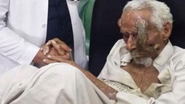 Pria Bertanduk Diyakini Berusia 140 Tahun Meninggal