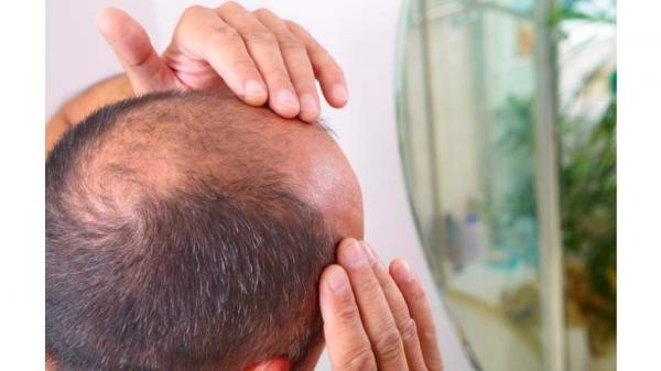 5 Cara Menumbuhkan Rambut di Jidat, Cocok Buat yang Mengalami Kebotakan