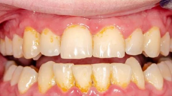 5 Cara Membersihkan Karang Gigi yang Sudah Mengeras secara Alami