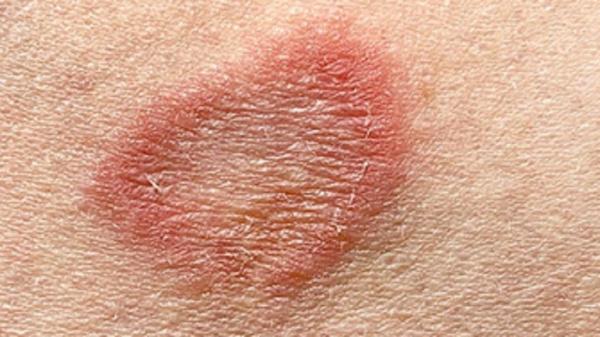 Apa Itu Ringworm? Penyakit Kulit yang Belakangan Viral di Kalangan Anak ...