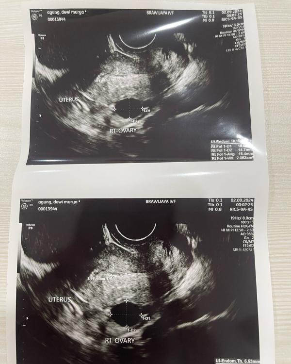 Foto USG Dewi Perssik Foto USG Dewi Perssik