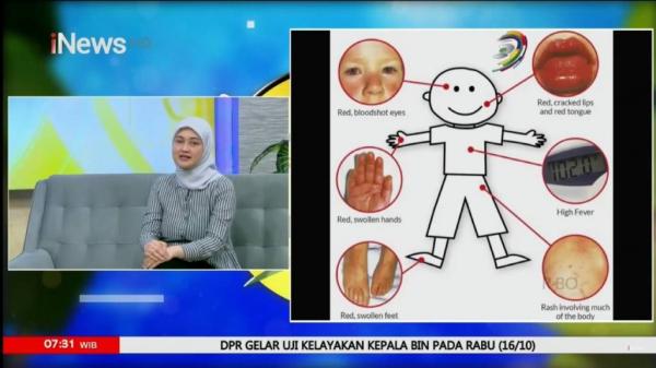 Gejala penyakit Kawasaki Gejala penyakit Kawasaki dijelaskan dalam program Morning Update iNews TV, Rabu (16/10/2024). (Foto: iNews TV)