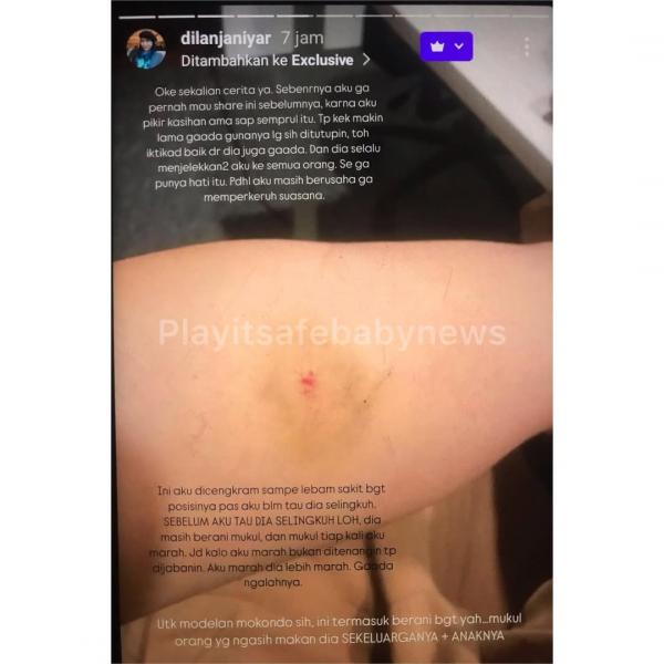 Luka Lebam Dilan Janiyar Luka Lebam Dilan Janiyar, diduga akibat KDRT yang dilakukan Safnoviar Tiasdi. (Foto: Instagram)