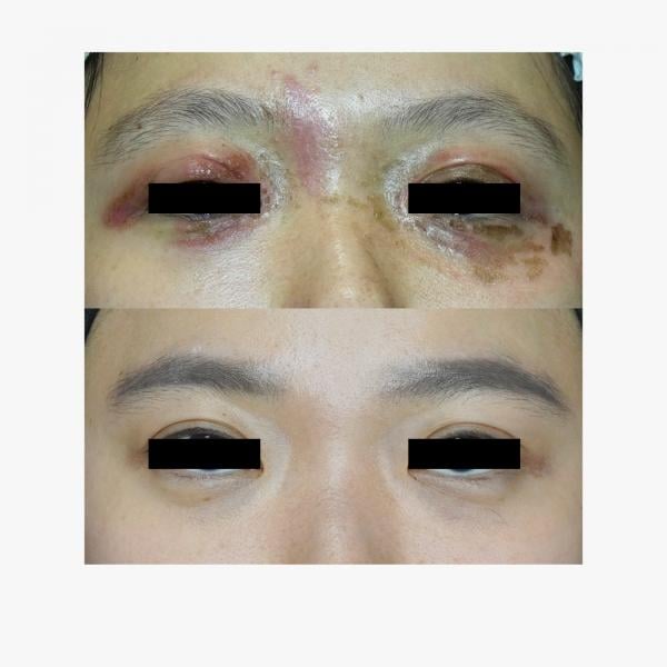 Serangan tomcat Gigitan tomcat. (Foto: Haju Medical)