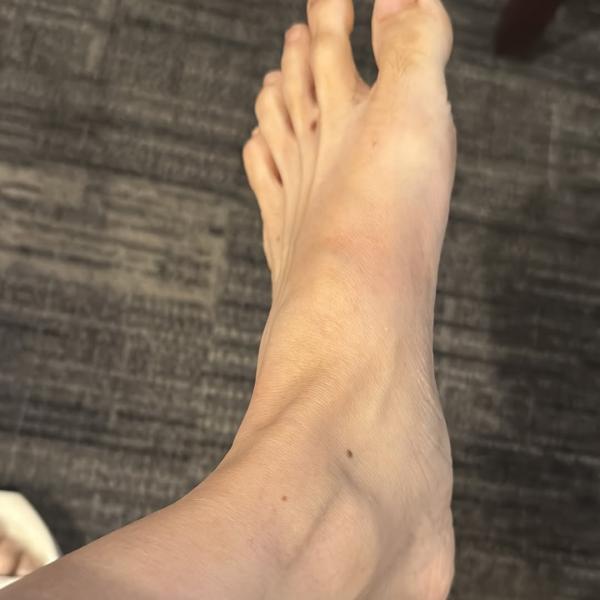 Kaki Ussy Kaki Ussy Sulistiawaty cedera. (Foto: Instagram)