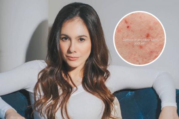 Jerawat Wulan Guritno Jerawat Wulan Guritno. (Foto: Instagram)