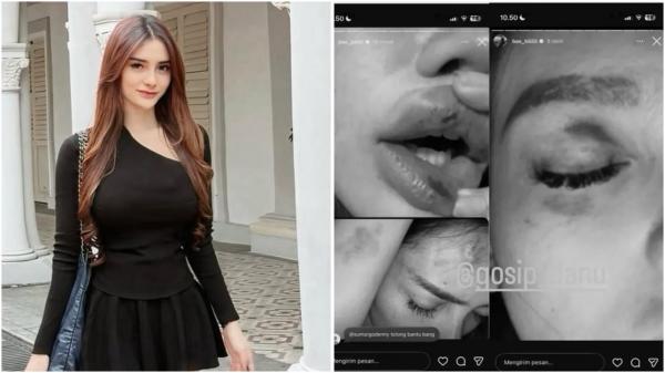 Selebgram Aprillya Nabilla diduga dipukuli hingga babak belur oleh sosok misterius. (Foto: Instagram)
