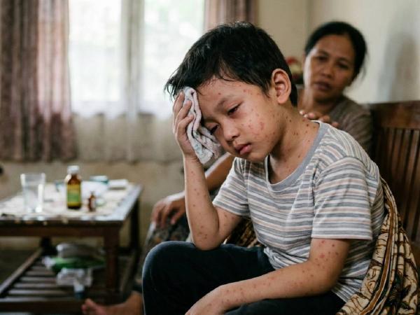 Penyakit campak gampang menular ke orang lain. (Foto: Ilustrasi AI)