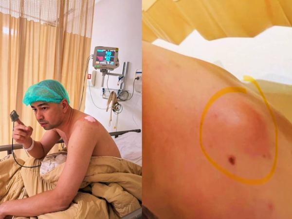 Raffi Ahmad ternyata operasi menghilangkan benjolan di bahu. (Foto: Instagram)