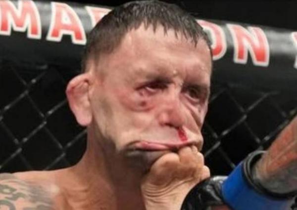 Sadis! Frankie Edgar, Wajah Petarung UFC Rusak Usai Ditendang KO Brutal Musuhnya