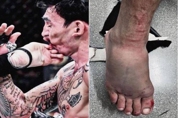 Mengerikan, Wajah Petarung UFC Rusak Ditendang, Kaki Musuhnya Patah