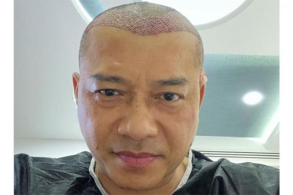 Viral! Anang Hermansyah Transplantasi Rambut, Netizen Sebut Mirip Raul Lemos