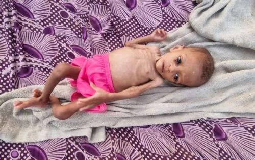 Bencana Malnutrisi Anak Akibat Harga Pangan Naik, Imbas Perang Rusia-Ukraina. Ini Kata UNICEF