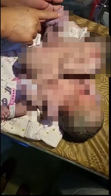 Lahir Secara Caesar, Bayi Kembar Siam Asal Asahan Dirujuk ke RSUP Haji Adam Malik Medan