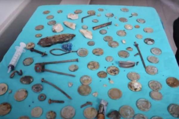 Ratusan Koin, Paku, Baterai dan Pecahan Kaca Ditemukan di dalam Perut Pasien di Turki 