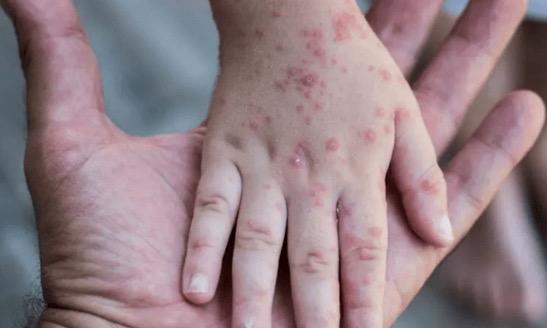 Indonesia Belum Siapkan Vaksinasi Monkeypox, IDI: Terapkan PHBS