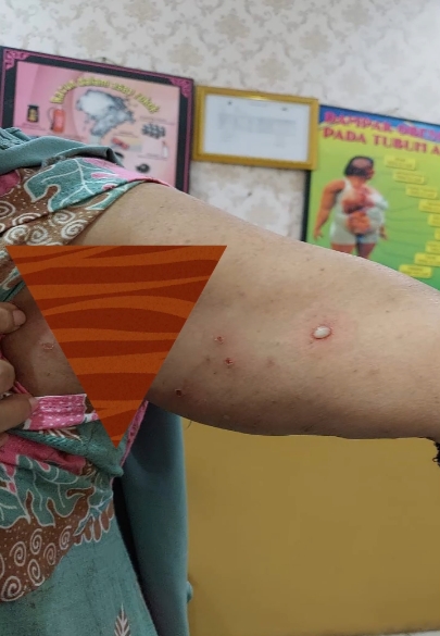 Wanita Lansia Asal Cilegon Suspect Cacar Monyet (monkeypox), Begini Kondisinya