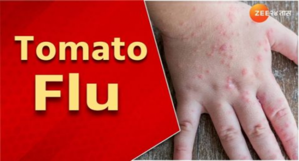 India Sedang Marak Flu Tomat, Apa Itu? Begini Cirinya!