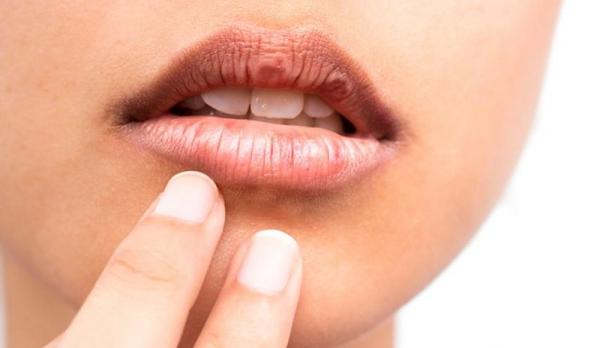 Tips Sederhana Mengatasi Bibir Kering dan Pecah-Pecah Secara Alami