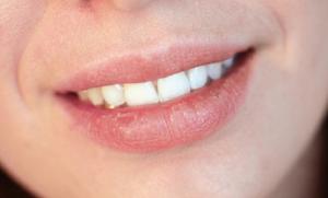 4 Cara Mengatasi Bibir Kering, Nomor 2 Jangan Merokok