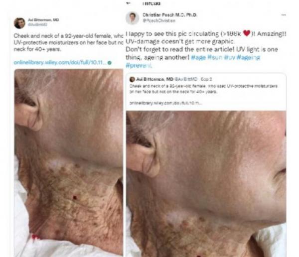Viral Penampakan Berbeda Kulit Wajah dan Leher Pada Nenek 92 Tahun