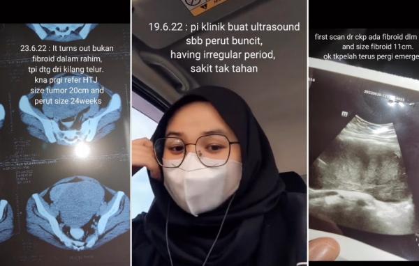 Kisah Perempuan Malaysia, Mengira Hamil 24 Minggu, Ternyata Tumor Ganas Dalam Perut