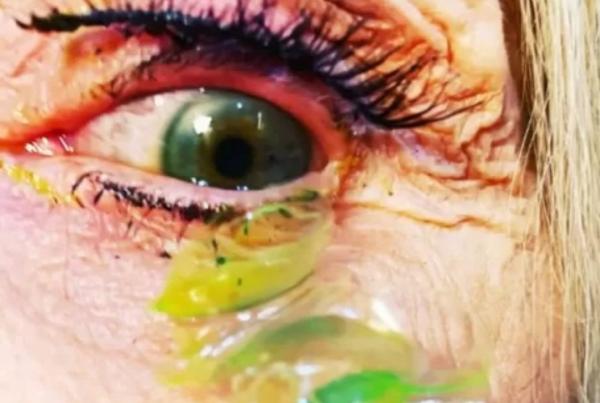 Mengerikan! Dokter Lepaskan 23 Lensa Kontak dari Mata Seorang Wanita