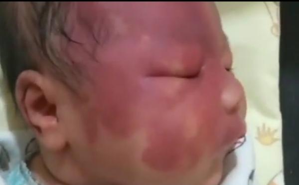 Deretan Tanda Merah Berdasarkan Primbon Jawa Pada Bayi, Ini Artinya
