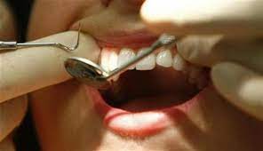 Perawatan Gigi Sangatlah Penting, Guna Pencegahan Gangguan Saraf