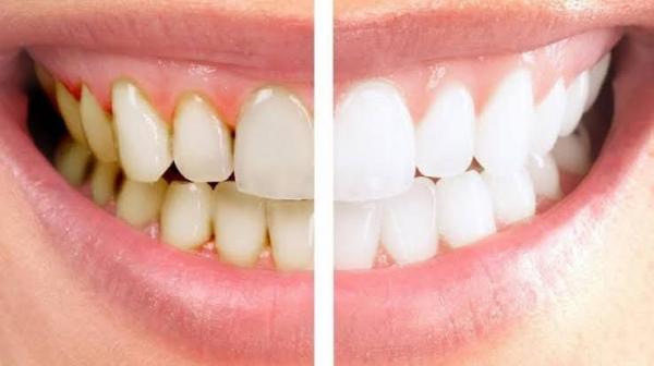 Terbukti Ampuh! Ini Cara Efektif Bersihkan Karang Gigi yang Menebal, Cukup dengan Baking Soda