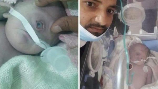 Viral! Lahir Bayi Bermata Satu di Yaman, Kasus yang Sangat Langka di Dunia Medis
