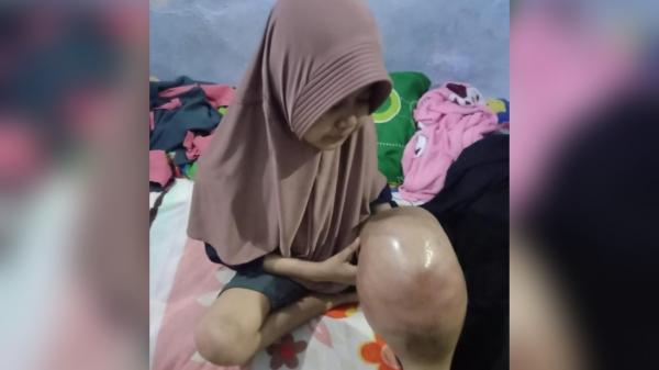 Malang Nian, Remaja di Probolinggo Ini Mengidap Kanker Tulang