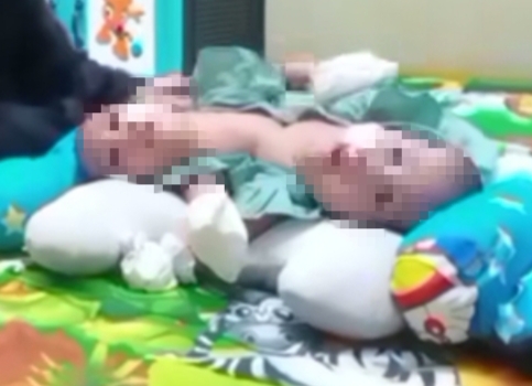 Pilu! Bayi Kembar Siam Asal Lebak Tak Punya Biaya untuk Operasi Pemisahan