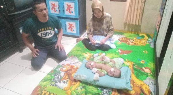 Bayi Kembar Siam Dempet Dada di Cikulur Lebak Butuh Tindakan Medis Khusus