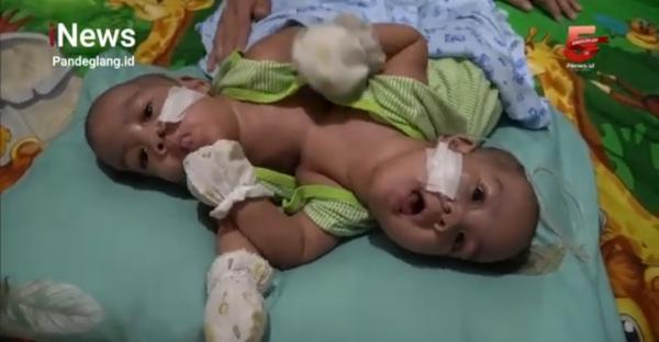 Begini Penampakan Bayi Kembar Siam Dempet Dada dan Hati di Cikulur Lebak yang Butuh Tindakan Medis