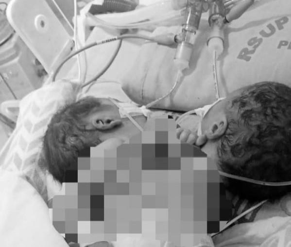 Orangtua Bayi Kembar Siam Dempet Dada Asal Kabupaten Batubara Memohon Bantuan Bupati