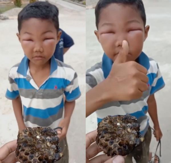 Bikin Ngakak! Bocah ini Balas Dendam ke Lebah Vespa yang Bikin Wajahnya Bengkak