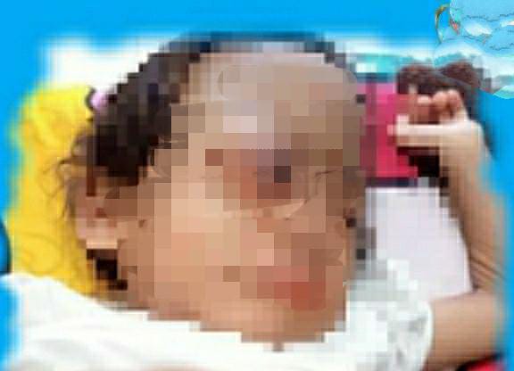 Butuh Bantuan Dermawan! Seorang Balita di Bayah Lebak Menderita Tumor Otak hingga Tak Bisa Melihat