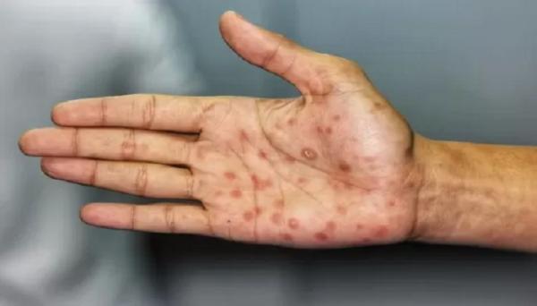 Terbanyak Kedua di Indonesia, Dinkes Jabar Gencar Skrining Penyakit Sifilis