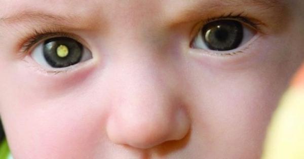 Waspada! Kenali Retinoblastoma: Kanker Mata pada Anak