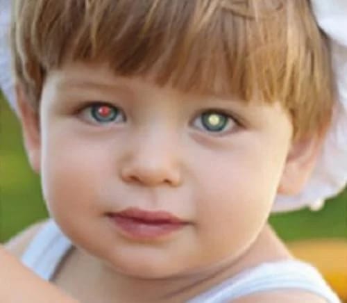 Yuk Simak Apa Itu Retinoblastoma atau Kanker Mata yang Banyak Menyerang Anak-Anak