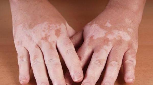 Panduan Terlengkap Mengenai Vitiligo: Penyebab, Gejala, dan Pilihan Terapi