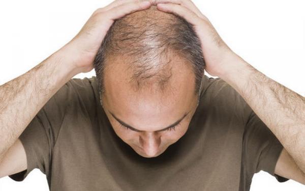 Inilah Alasan Kenapa Rambut Atas Pria Kebanyakan Botak Saat Masih Muda