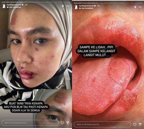 Wajah hingga Lidah Kartika Putri Melepuh, Netizen: Azab Suka Julid