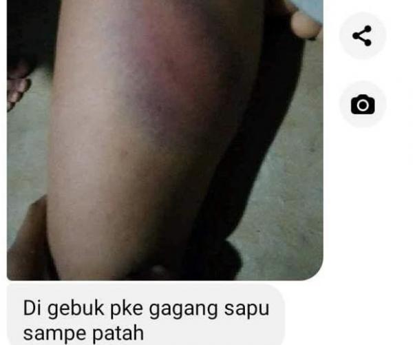 Quick Respon, Polisi Padang Jaya Dalami Dugaan Kasus KDRT Istri dipukul Suaminya hingga Membiru 